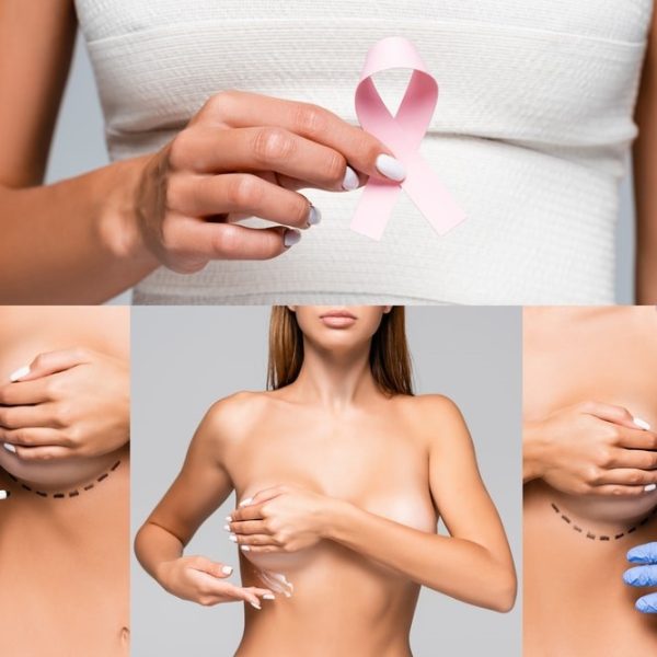 Quando si affronta un intervento chirurgico alla mammella per una patologia oncologica, la priorità assoluta resta sempre la sicurezza oncologica: rimuovere il tumore in modo completo e appropriato.